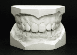 گچ دندانپزشکی